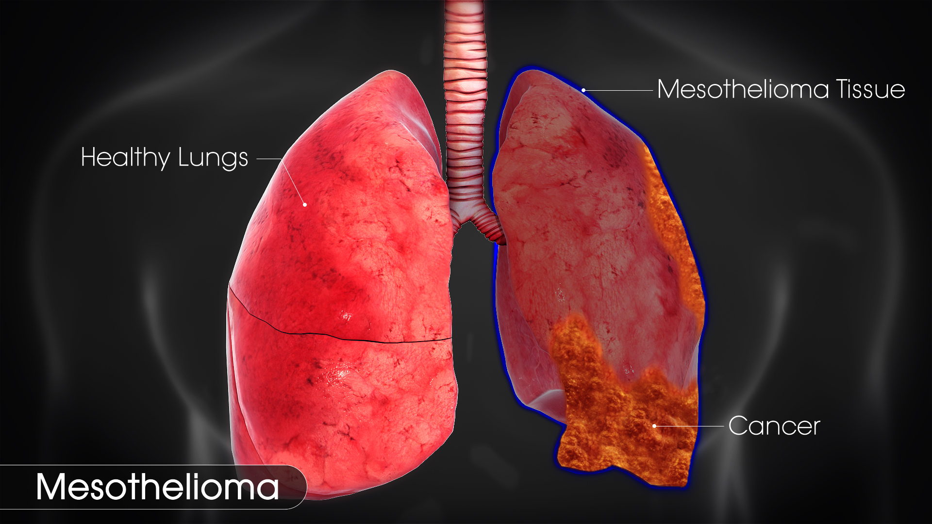 Mesothelioma laywer Directory