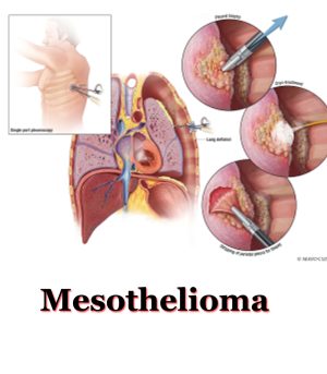 Mesothelioma Lawyer directory