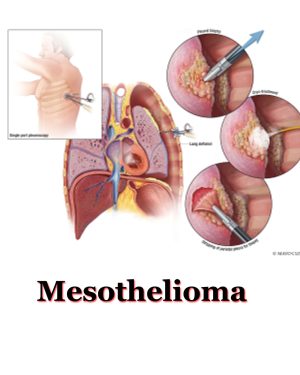 TOP 5 Best Mesothelioma lawyer directory